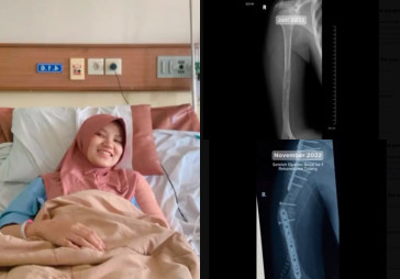 Heboh Kisah Wanita yang Awalnya Pegal-pegal Biasa Ternyata Derita Kanker Tulang, Ini Penyabab dan Gejalanya